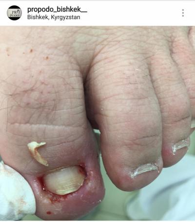 Подология.Медицинский аппаратный педикюр.